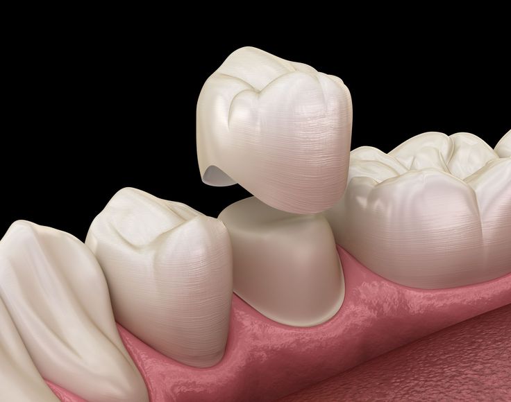 dental crown restoration