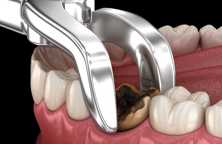 tooth removal dental extraction