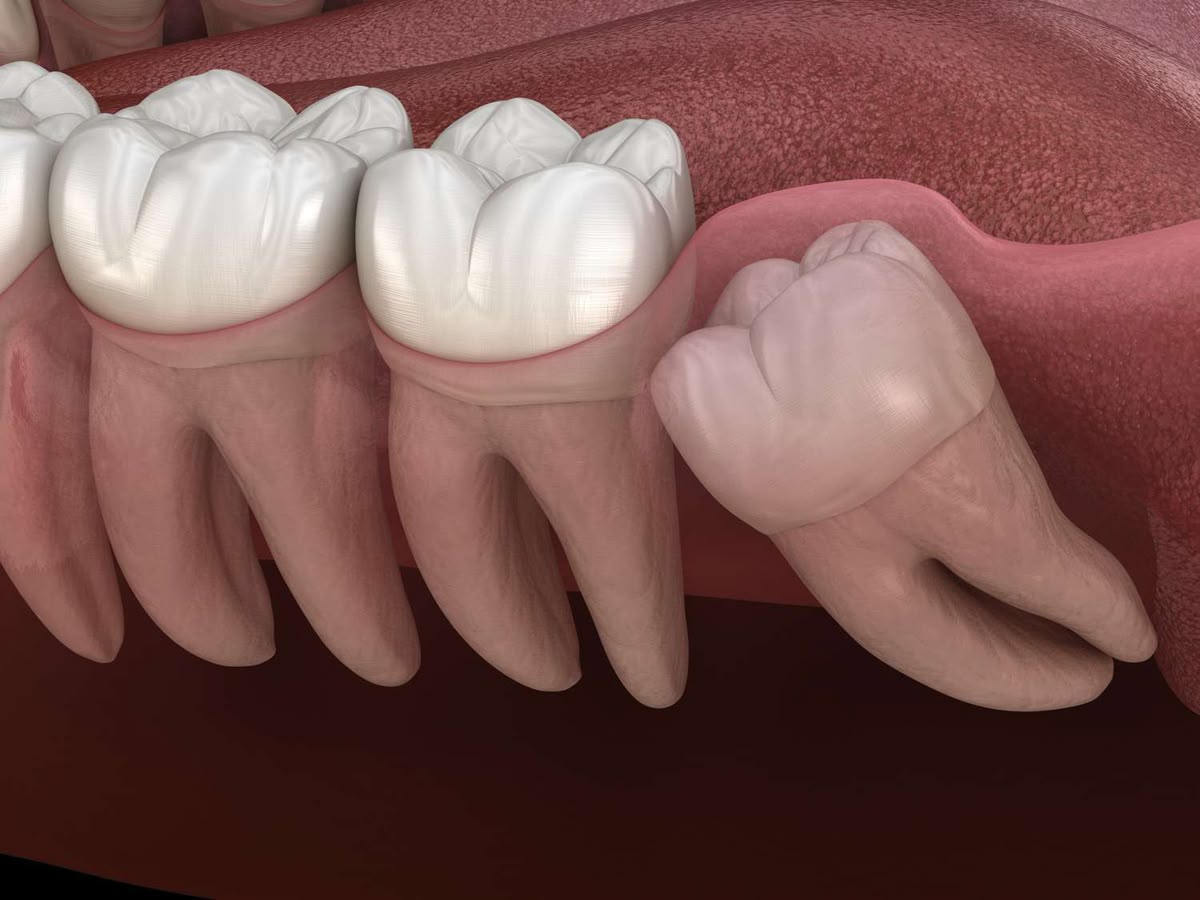 wisdom tooth extraction